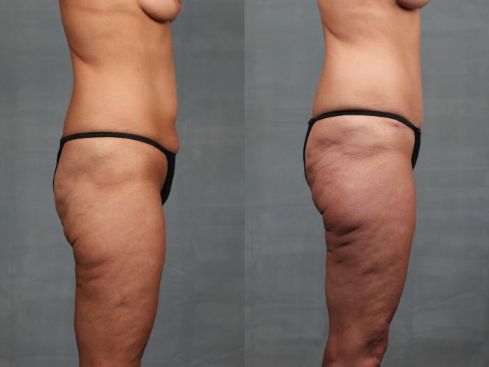 Before & After Mommy Makeover Case 738 Right Side - Bottom View in Louisville & Lexington, KY