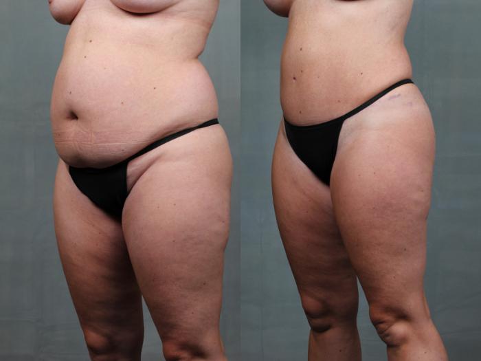 Before & After Mommy Makeover Case 739 Left Oblique View in Louisville & Lexington, KY