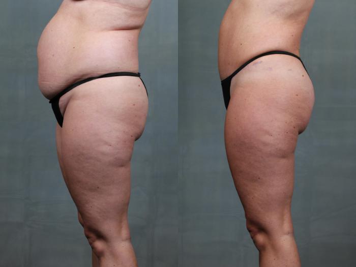 Before & After Mommy Makeover Case 739 Left Side View in Louisville & Lexington, KY