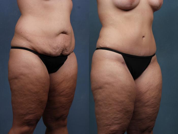 Before & After Mommy Makeover Case 740 Right Oblique View in Louisville & Lexington, KY