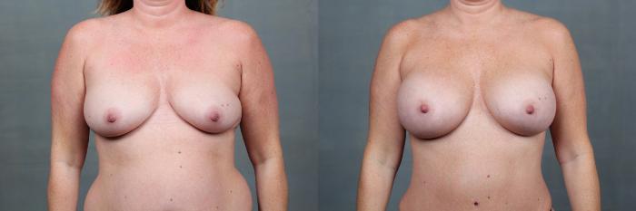 Before & After Mommy Makeover Case 741 Front View in Louisville & Lexington, KY