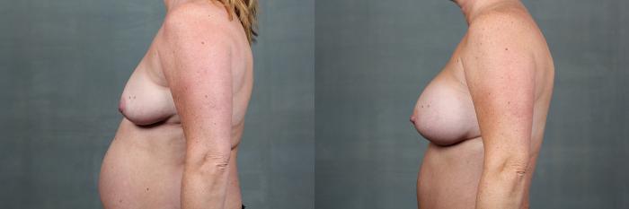 Before & After Mommy Makeover Case 741 Left Side View in Louisville & Lexington, KY