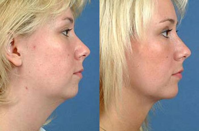 Before & After Neck Procedures Case 110 View #2 View in Louisville & Lexington, KY