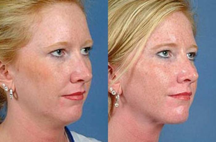 Before & After Neck Procedures Case 111 View #1 View in Louisville & Lexington, KY