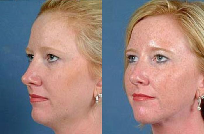 Before & After Neck Procedures Case 111 View #2 View in Louisville & Lexington, KY