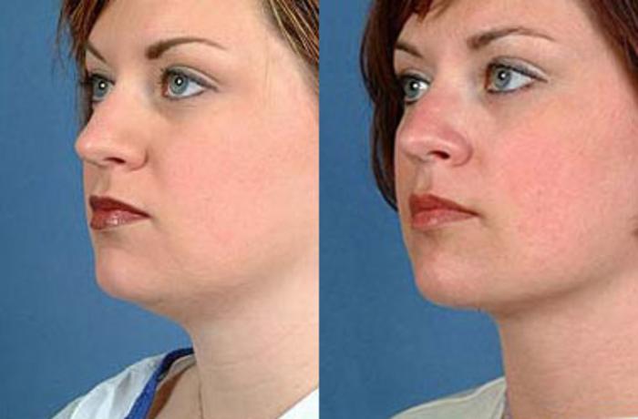 Before & After Neck Procedures Case 112 View #1 View in Louisville & Lexington, KY