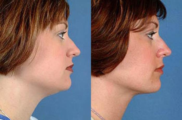 Before & After Neck Procedures Case 112 View #2 View in Louisville & Lexington, KY