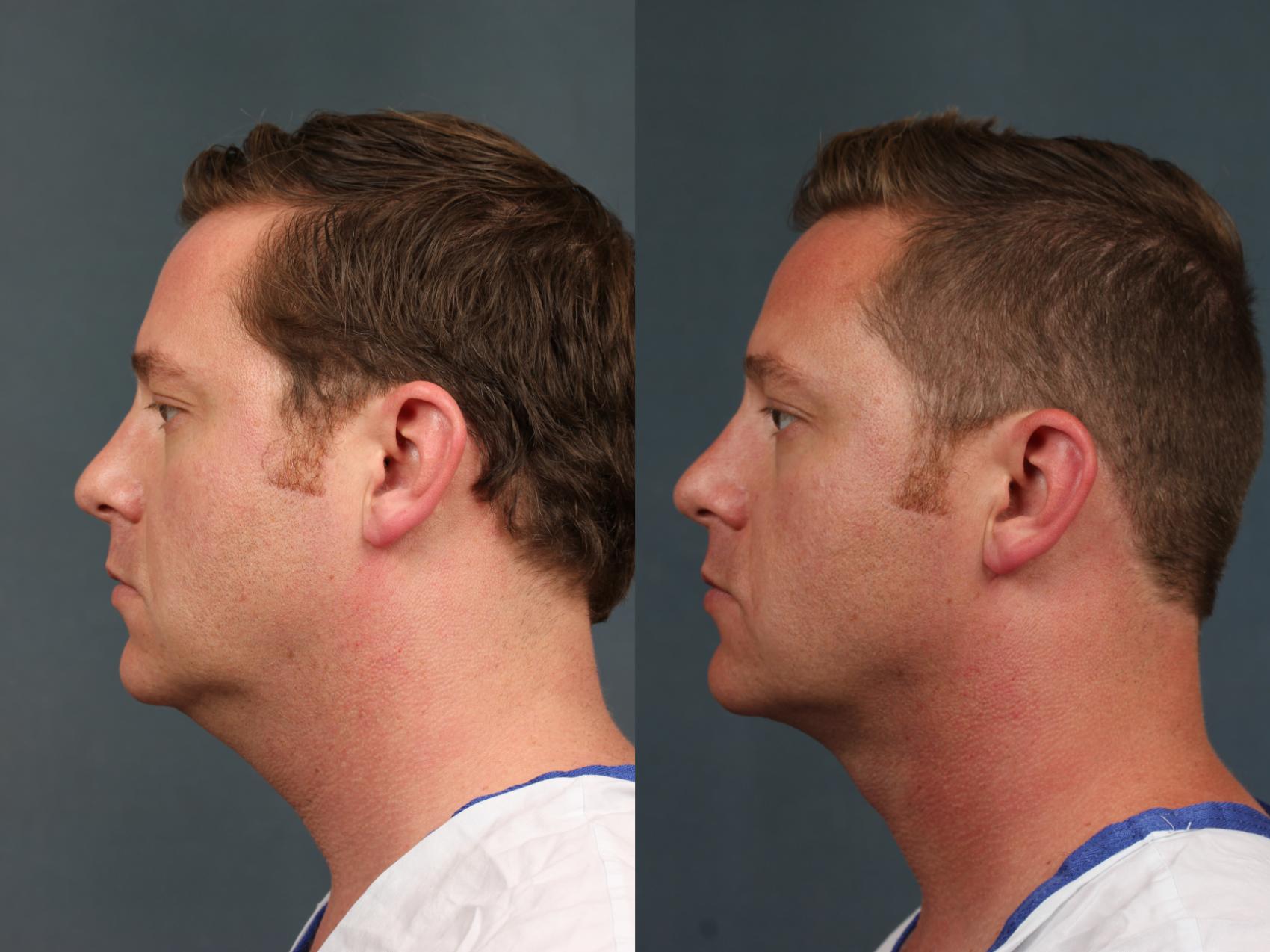 Before & After Neck Lift Case 726 Left Side View in Louisville, KY