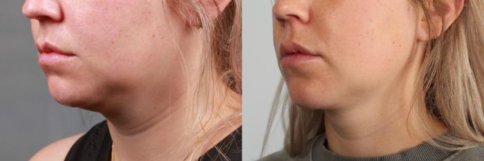 Before & After Liposuction for Women Case 760 Left Oblique View in Louisville & Lexington, KY