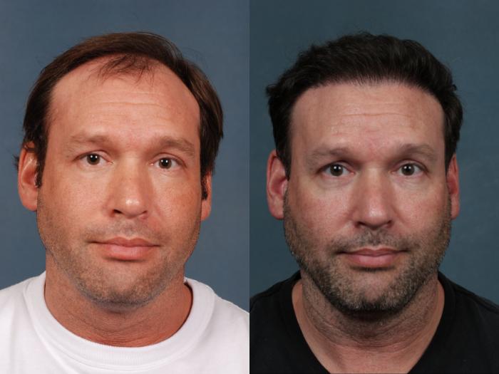 Before & After NeoGraft Hair Transplant Case 710 Front View in Louisville & Lexington, KY