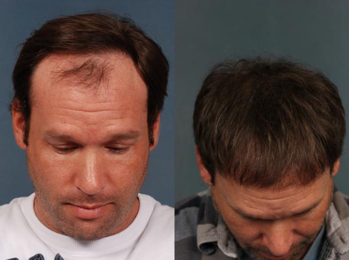 Before & After NeoGraft Hair Transplant Case 710 Top of Head View in Louisville & Lexington, KY