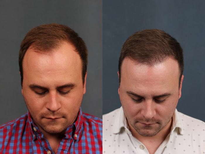 Before & After NeoGraft Hair Transplant Case 712 Front View in Louisville & Lexington, KY