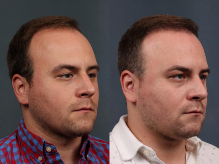 Before & After NeoGraft Hair Transplant Case 712 Right Oblique View in Louisville & Lexington, KY