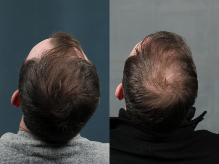 Before & After NeoGraft Hair Transplant Case 713 Back View in Louisville & Lexington, KY