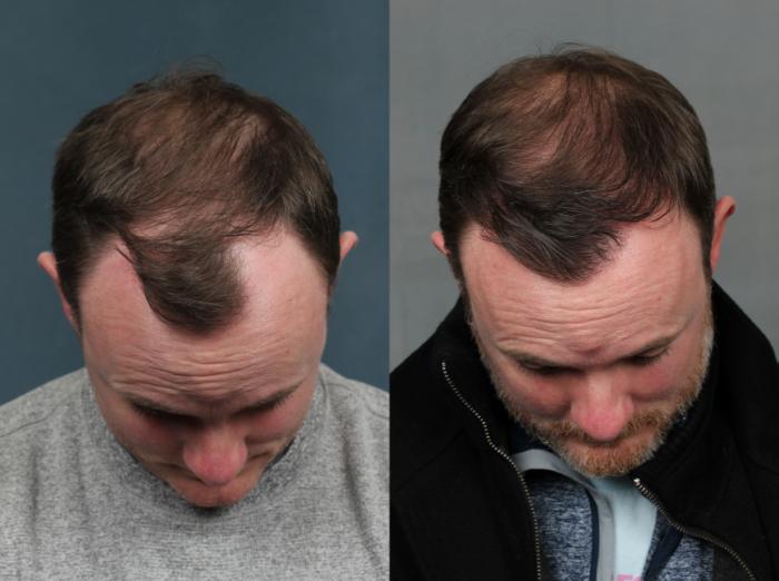 Before & After NeoGraft Hair Transplant Case 713 Front View in Louisville & Lexington, KY