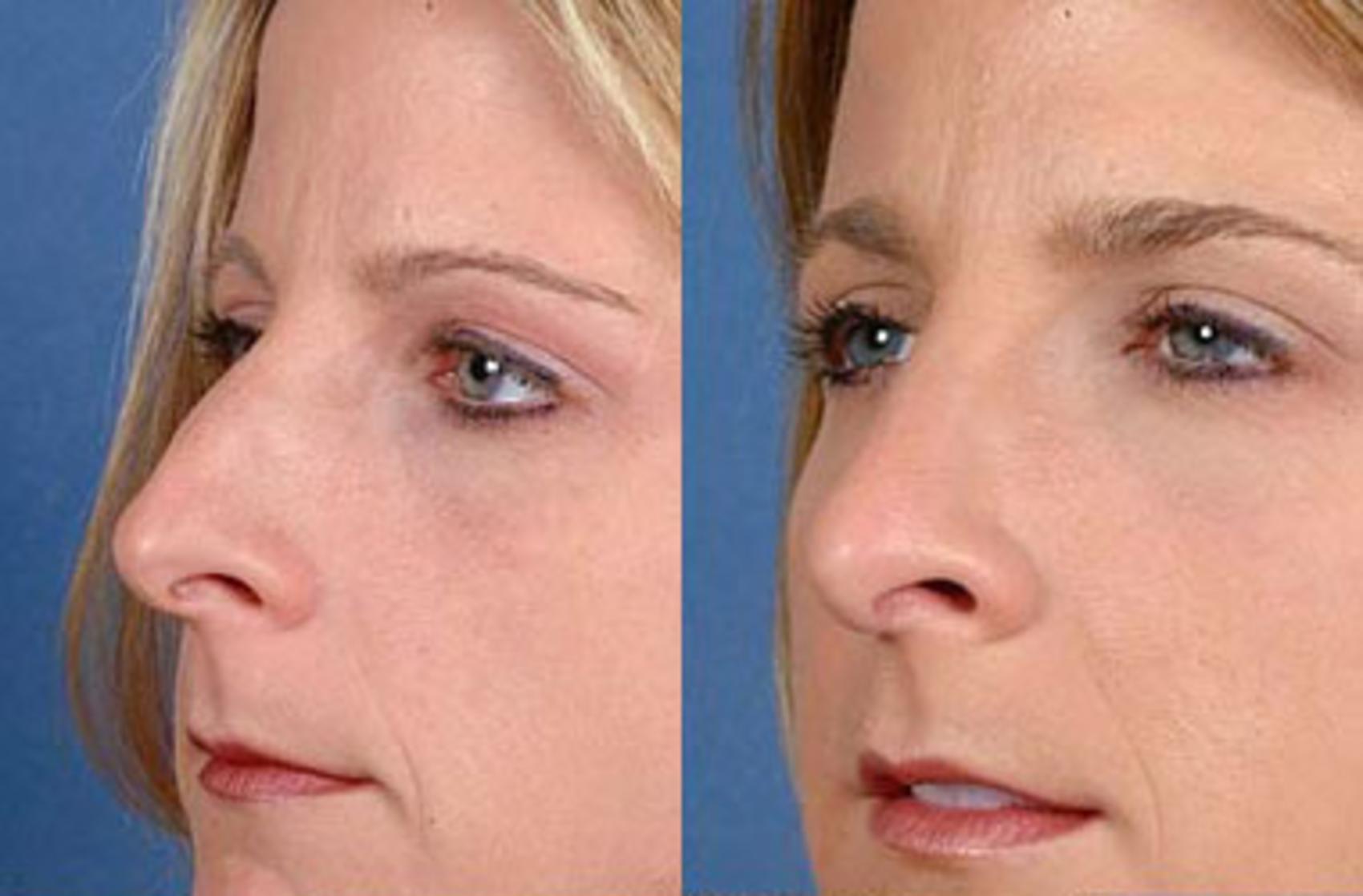 Before & After Nose Reshaping Case 100 View #1 View in Louisville, KY