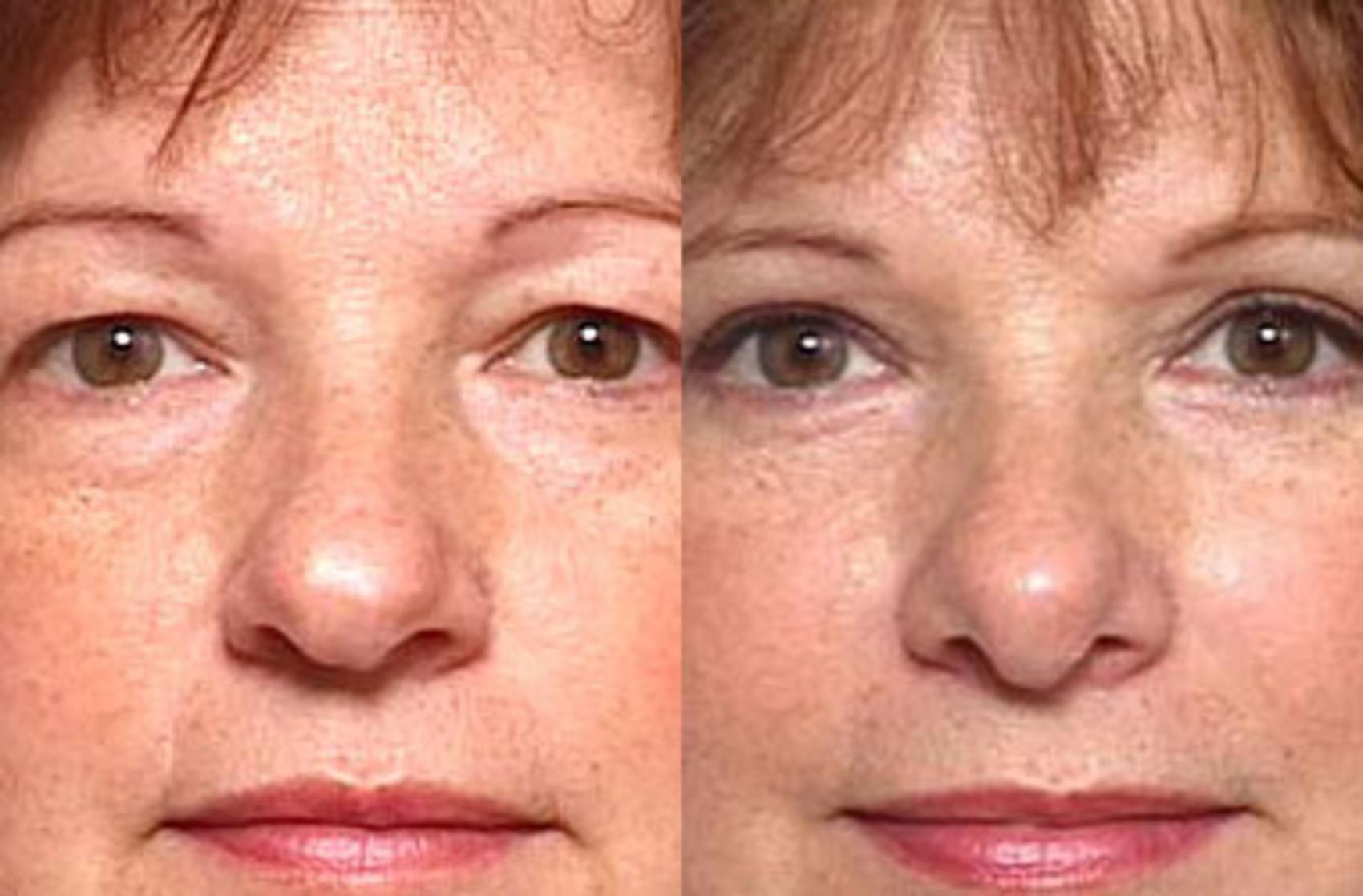 Before & After Nose Reshaping Case 101 View #1 View in Louisville, KY