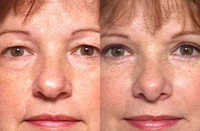 Before & After Nose Reshaping Case 101 View #1 View in Louisville & Lexington, KY