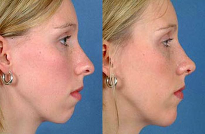 Before & After Nose Reshaping Case 102 View #1 View in Louisville & Lexington, KY