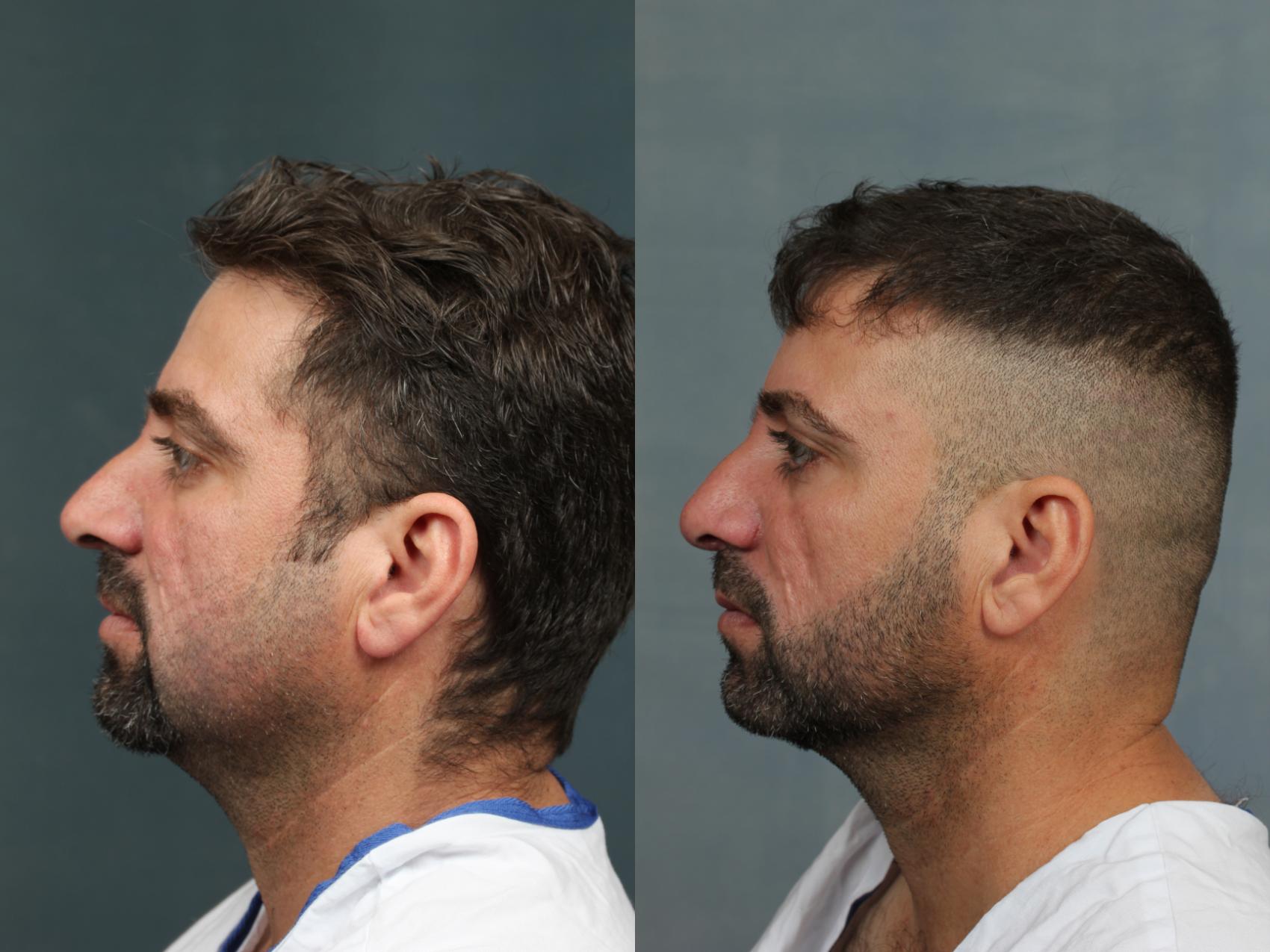 Before & After Nose Reshaping Case 731 Left Side View in Louisville, KY