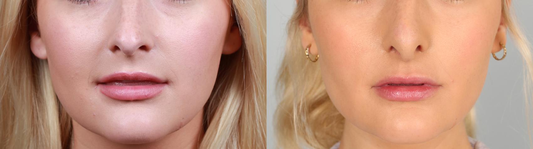Before & After Nose Reshaping Case 761 Front View in Louisville & Lexington, KY