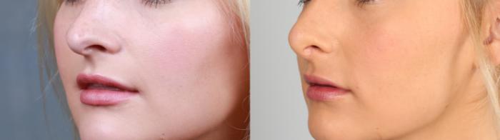 Before & After Nose Reshaping Case 761 Left Oblique View in Louisville & Lexington, KY