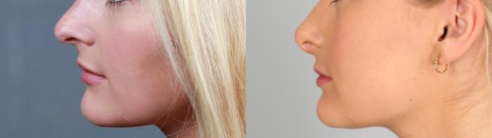 Before & After Nose Reshaping Case 761 Left Side View in Louisville & Lexington, KY