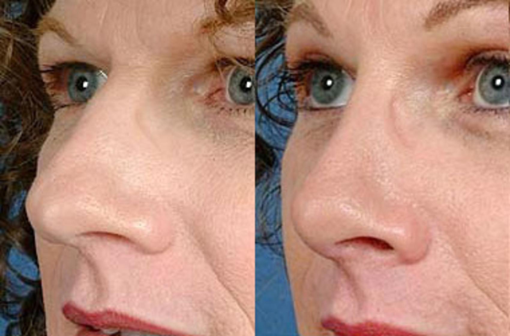 Before & After Nose Reshaping Case 99 View #1 View in Louisville, KY