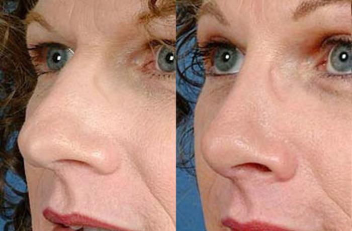 Before & After Nose Reshaping Case 99 View #1 View in Louisville & Lexington, KY