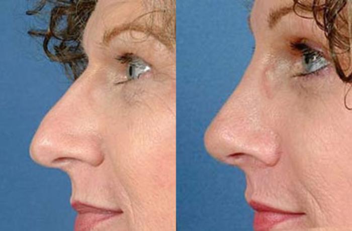 Before & After Nose Reshaping Case 99 View #2 View in Louisville & Lexington, KY