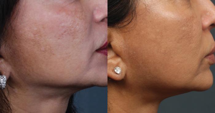 Before & After PICO Genesis Laser Treatment Case 683 Right Side View in Louisville & Lexington, KY