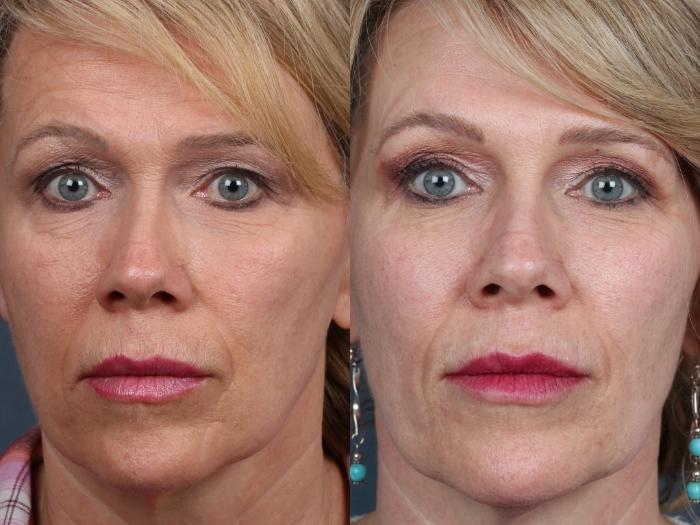 Before & After PICO Genesis Laser Treatment Case 688 Front View in Louisville & Lexington, KY