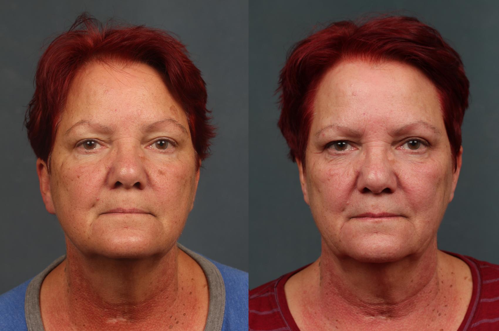 Before & After PICO Genesis Laser Treatment Case 695 Front View in Louisville, KY