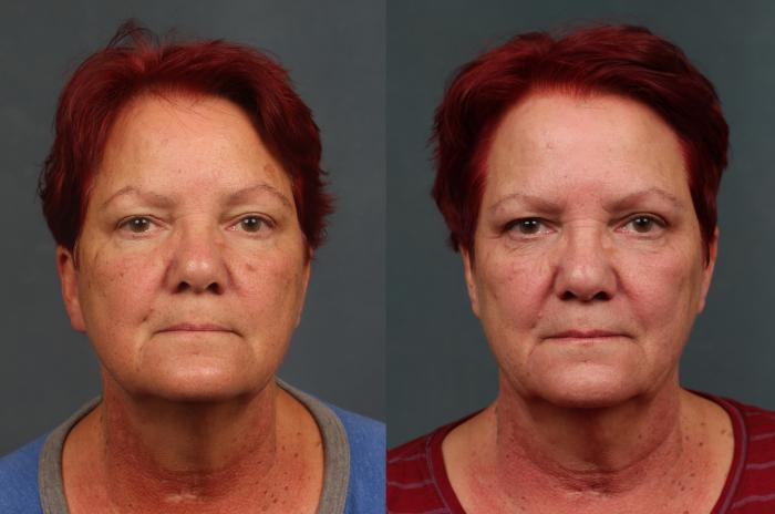 Before & After PICO Genesis Laser Treatment Case 695 Front View in Louisville & Lexington, KY