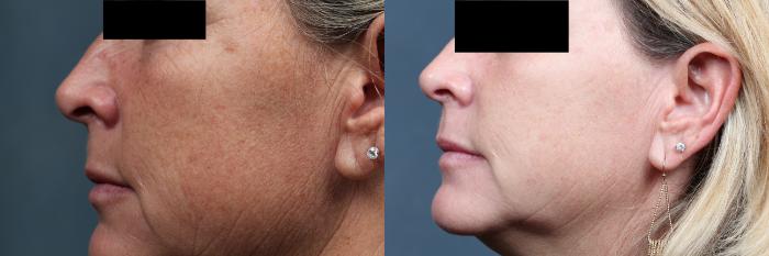 Before & After PICO Genesis Laser Treatment Case 700 Left Side View in Louisville & Lexington, KY