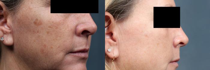 Before & After PICO Genesis Laser Treatment Case 700 Right Side View in Louisville & Lexington, KY
