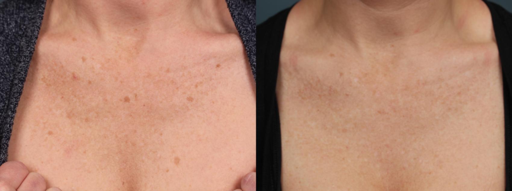 Before & After PICO Genesis Laser Treatment Case 703 Front View in Louisville & Lexington, KY