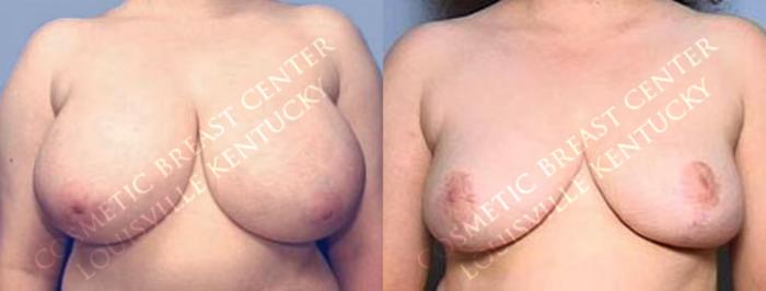 Reduction Case 56 Before & After View #1 | Louisville, KY | CaloSpa® Rejuvenation Center