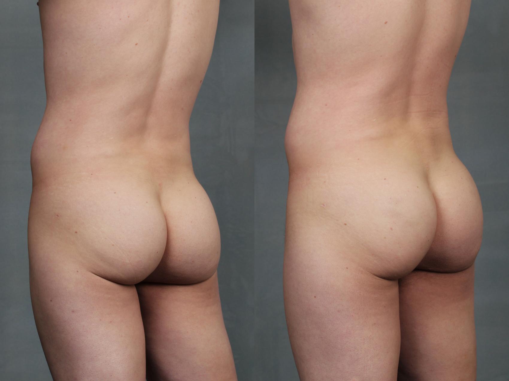 Before & After Sculptra for Buttocks Case 711 Back View in Louisville, KY