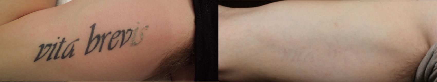 Before & After Tattoo Removal Case 681 Arm View in Louisville, KY