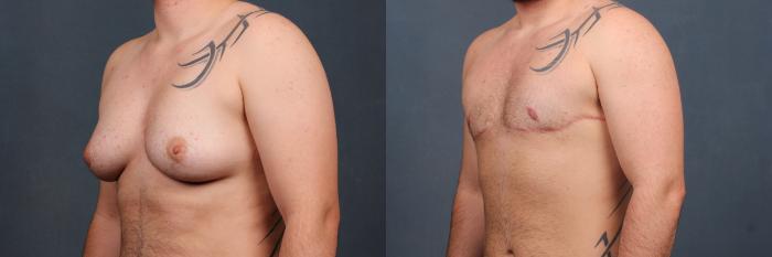 Top Surgery Case 562 Before & After View #2 | Louisville, KY | CaloSpa® Rejuvenation Center