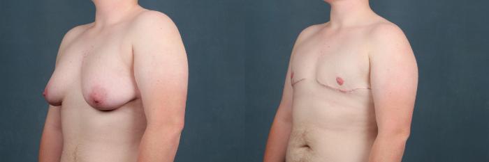 Top Surgery Case 564 Before & After View #2 | Louisville, KY | CaloSpa® Rejuvenation Center