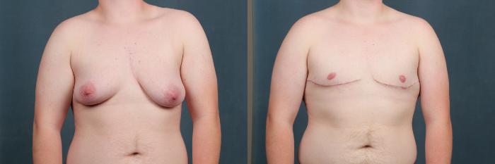 Before & After Top Surgery Case 733 Front View in Louisville & Lexington, KY