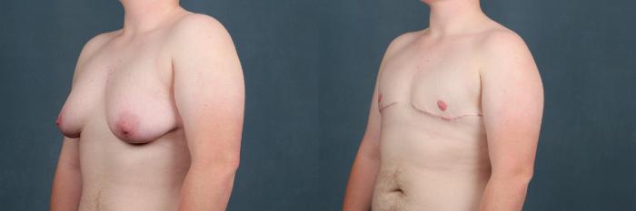 Before & After Top Surgery Case 733 Left Oblique View in Louisville & Lexington, KY