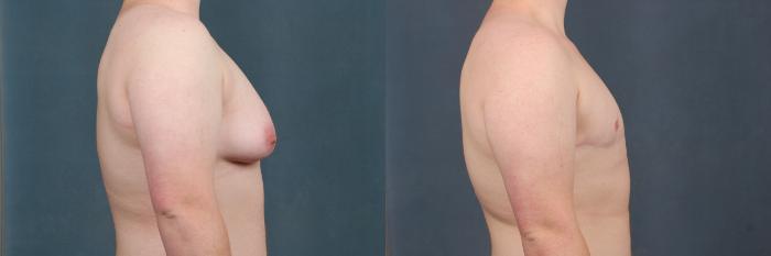 Before & After Top Surgery Case 733 Right Side View in Louisville & Lexington, KY