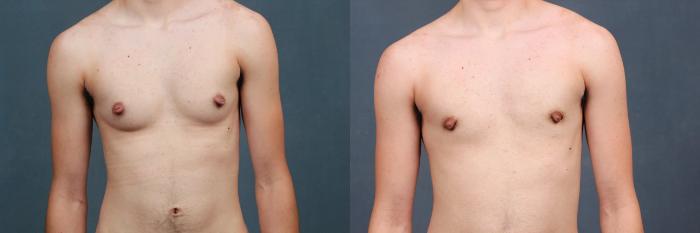 Before & After Top Surgery Case 734 Front View in Louisville & Lexington, KY