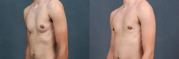 Before & After Top Surgery Case 734 Left Oblique View in Louisville & Lexington, KY