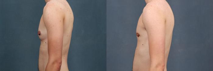 Before & After Top Surgery Case 734 Left Side View in Louisville & Lexington, KY