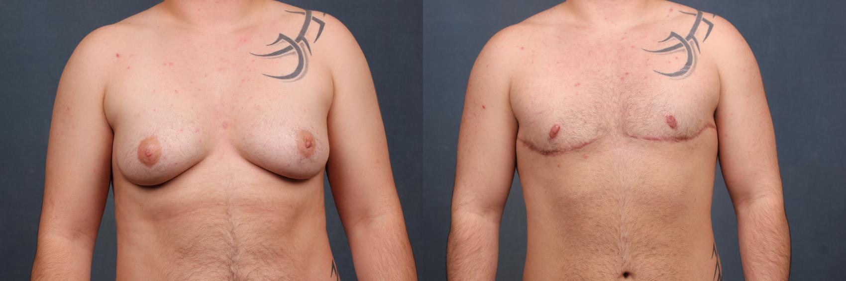 Before & After Top Surgery Case 735 Front View in Louisville, KY