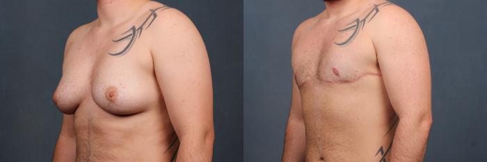Before & After Top Surgery Case 735 Left Oblique View in Louisville & Lexington, KY